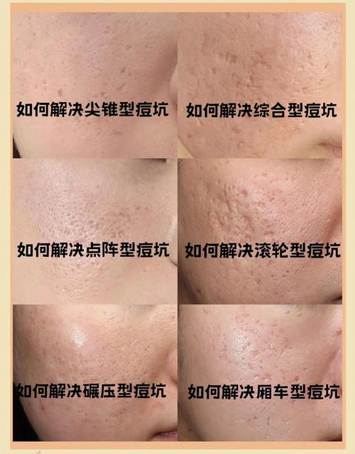 瓷肌祛痘效果究竟如何？-图3