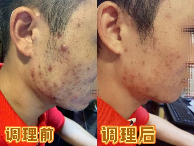 中药祛痘效果真的好吗?-图2 中药祛痘效果真的好吗?-图2