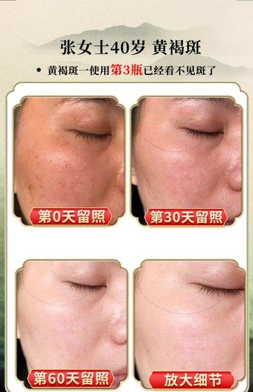 祛斑去痘印，什么方法最有效？-图2