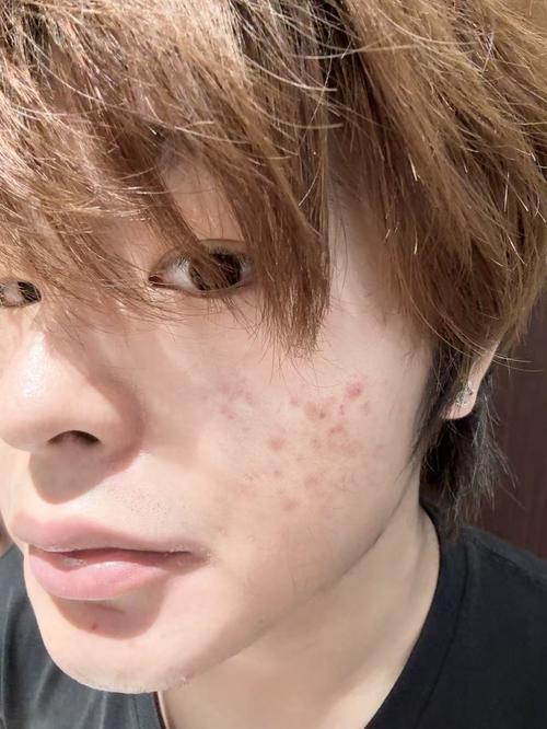 西瓜皮祛痘印几天见效？-图3