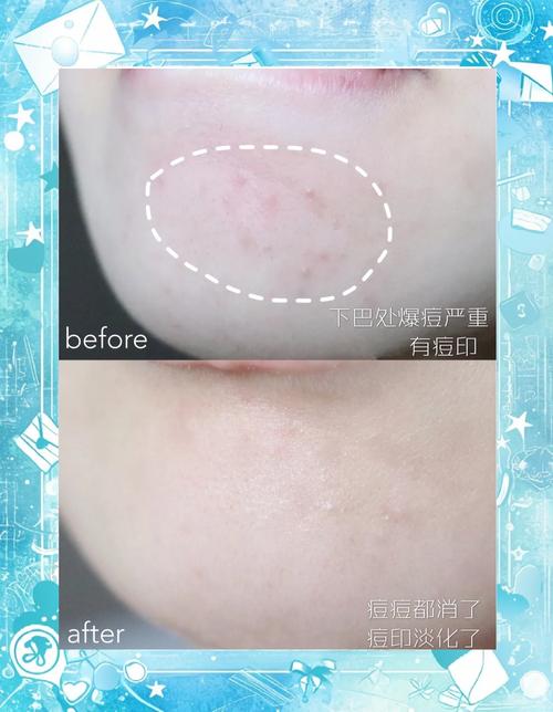 安美拉祛痘软膏效果真的好吗？-图1