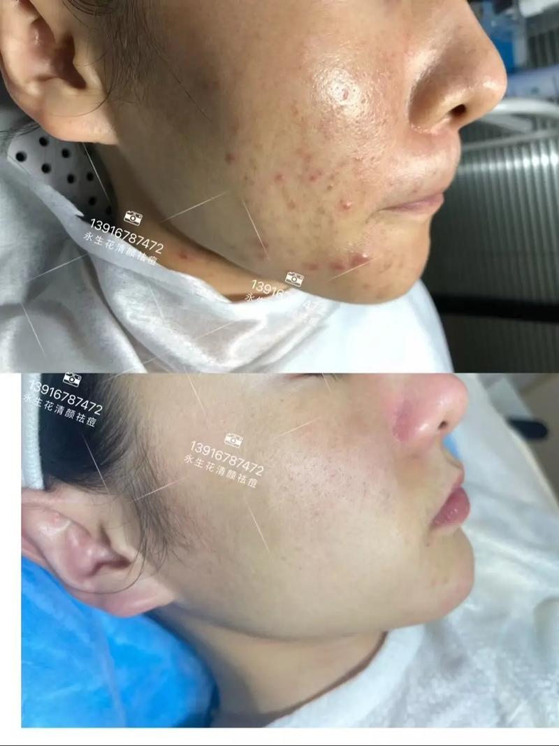 老中医祛痘真的有效吗？-图1