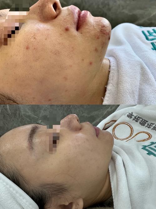 老中医祛痘真的有效吗？-图3