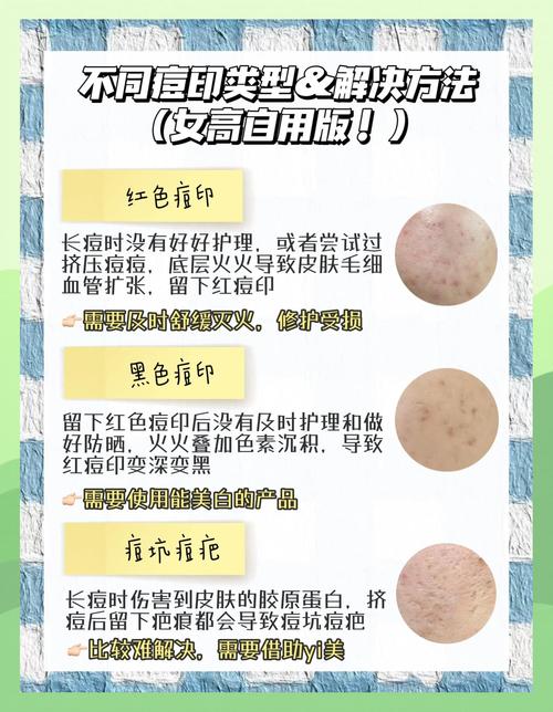 e光祛痘印后要注意什么？-图2