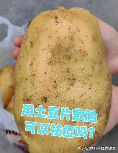 土豆片真能祛痘吗？-图1