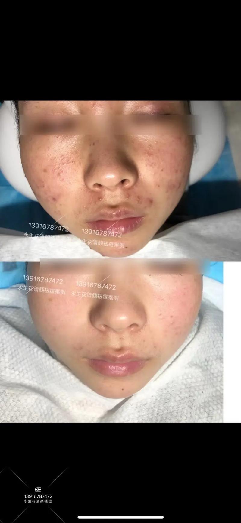 韩后祛痘达人效果到底如何？-图1