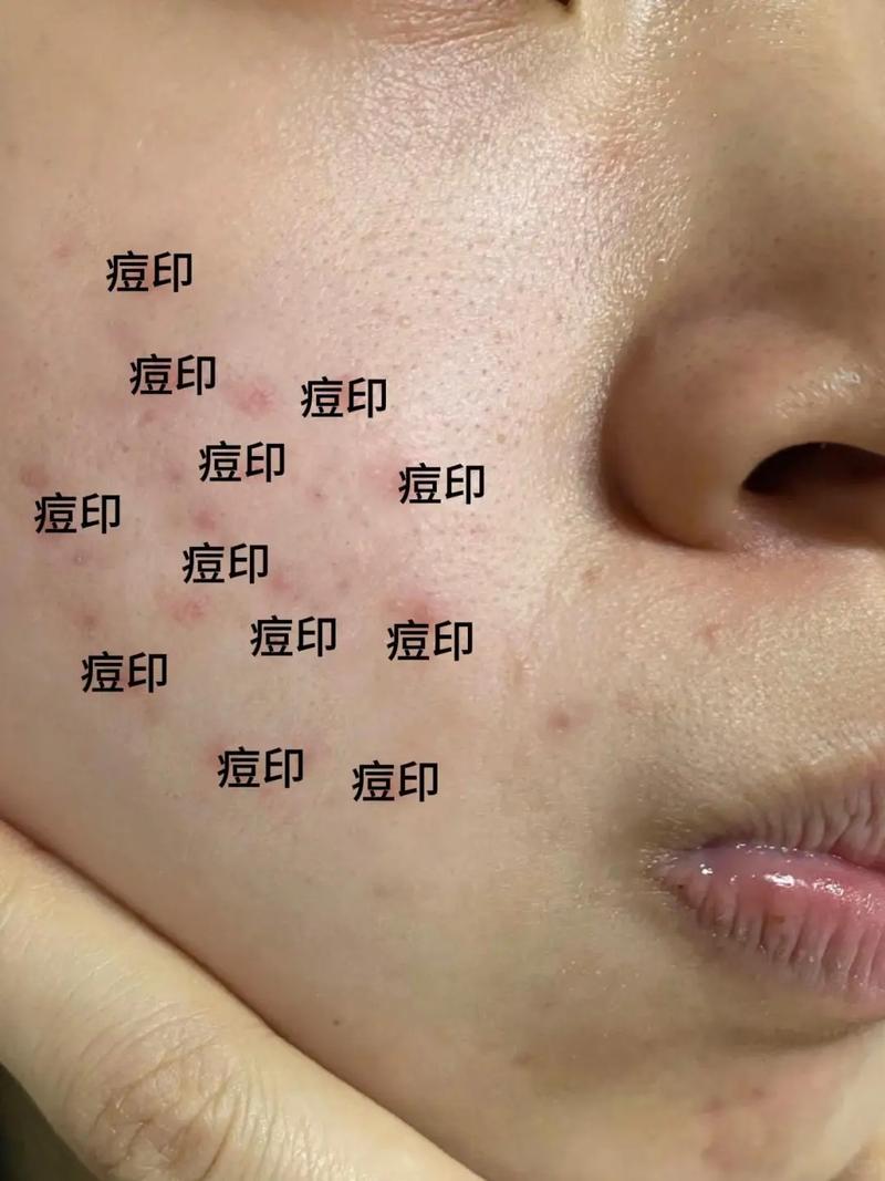 如何有效祛痘印？-图1