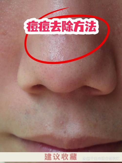 水氧活肤祛痘多久见效？-图3