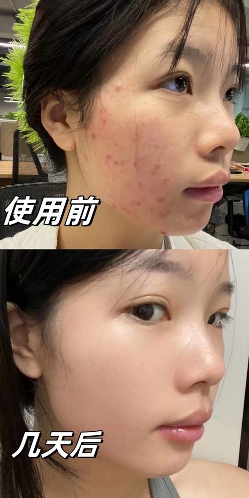 敬修堂祛痘效果到底好不好？-图3