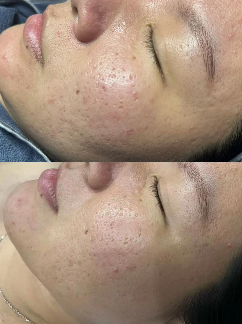 马油祛痘疤真的有效吗？-图1