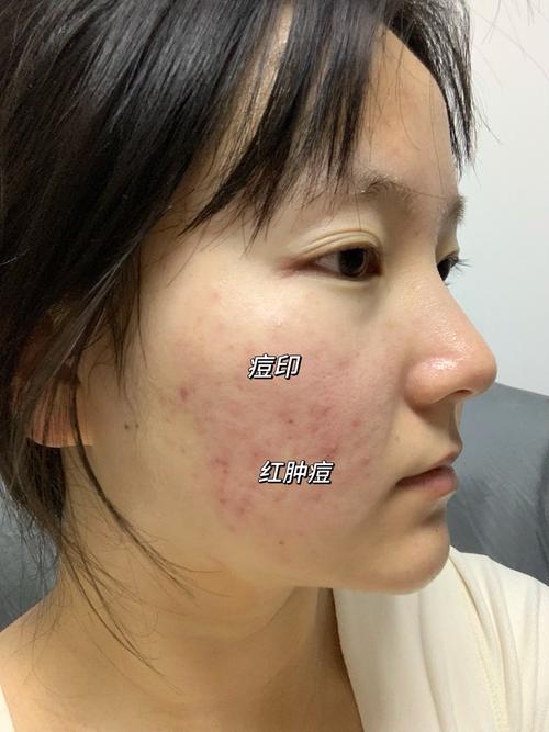 马油祛痘疤真的有效吗？-图3