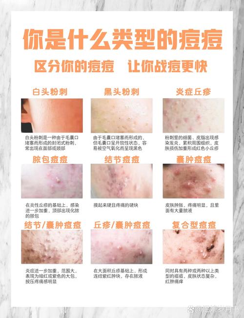 祛青春痘到底有什么好办法？-图1