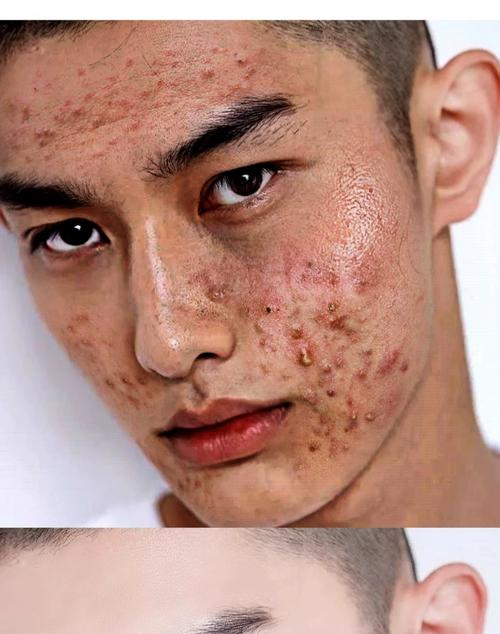 男生祛痘该用什么洗脸？-图1