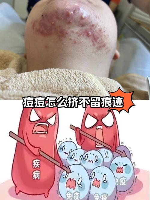 专业挤痘痘祛痘靠谱吗？-图1