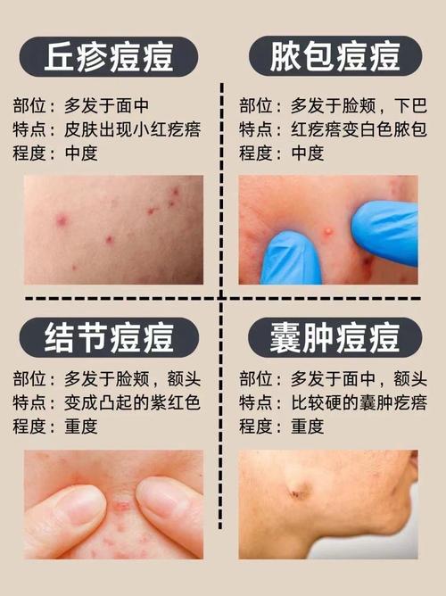 专业挤痘痘祛痘靠谱吗？-图2