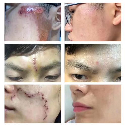 芦荟胶祛痘真的有效吗？-图1