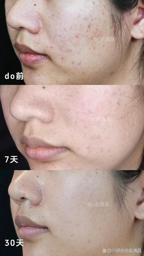 ve祛痘印效果真的好吗？-图1