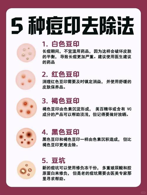 祛痘印有什么小窍门？-图3