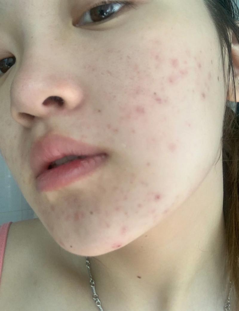 激光祛痘后痘痘会复发吗？-图3