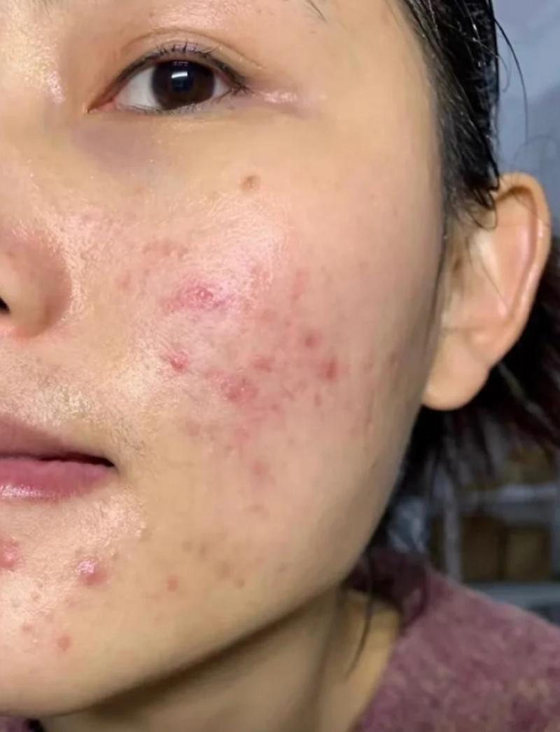 激光祛痘会留疤或反弹吗？-图3