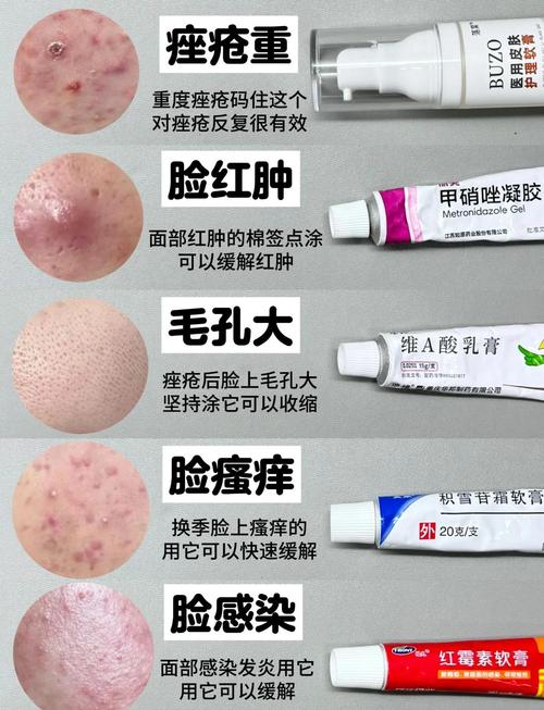 粉刺该用啥护肤品？-图3