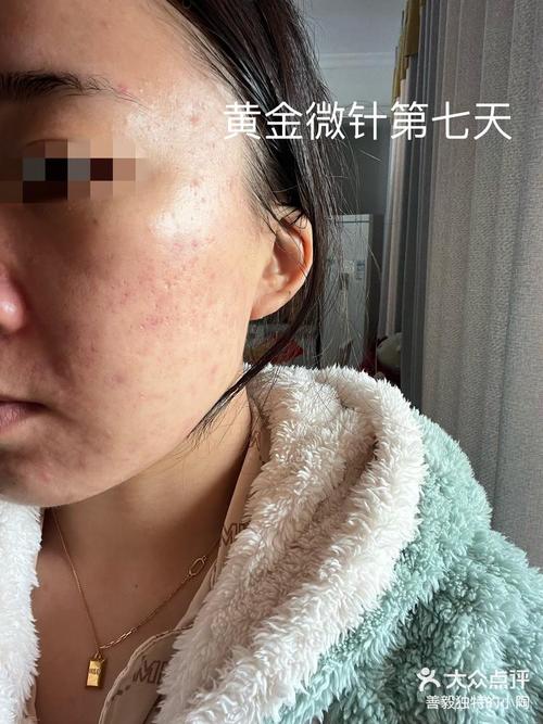 微针和激光祛痘，到底哪个更适合你？-图2