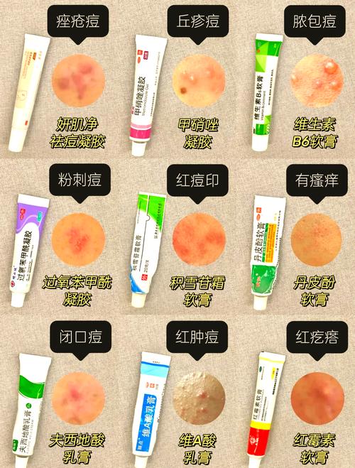 男生祛痘选什么产品好？-图1