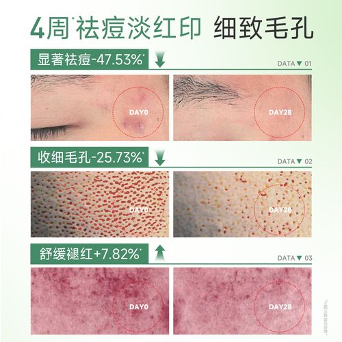 绿豆泥面膜祛痘真的有效吗？-图2