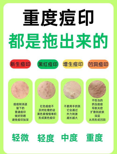 男生祛痘印美白，有哪些有效方法？-图3