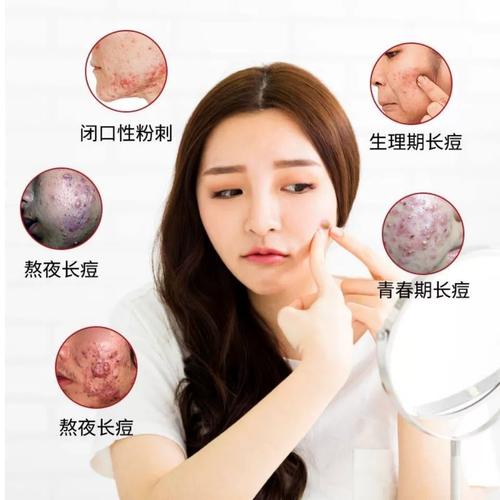 瓷肌祛痘套装怎么用？-图1