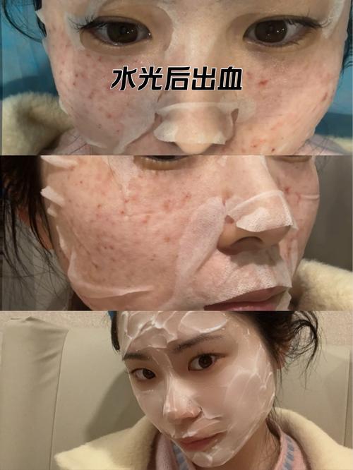 打水光针能祛痘印吗？-图2