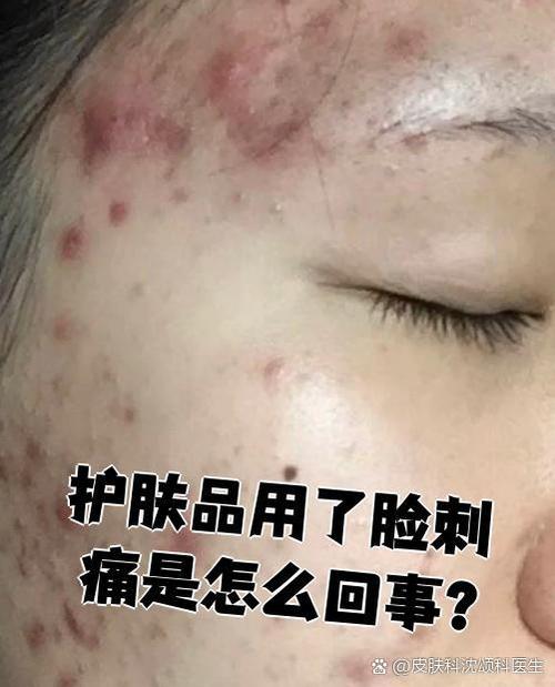 护肤品刺脸是过敏还是刺激？-图1