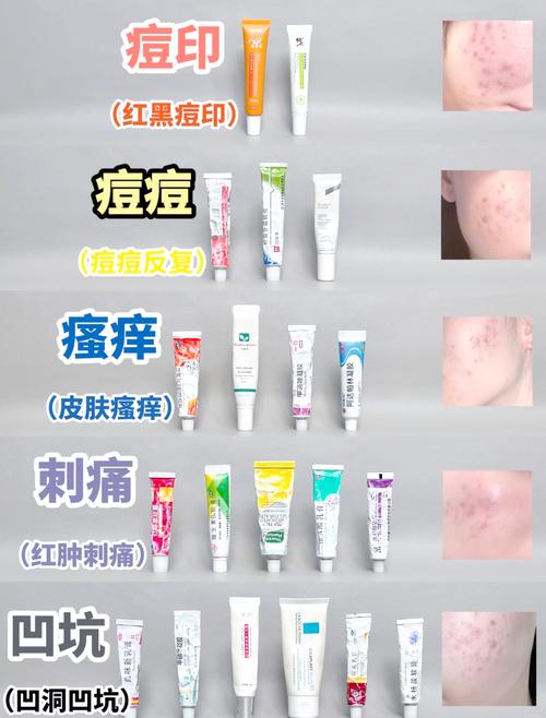 青软膏能祛痘吗？-图2