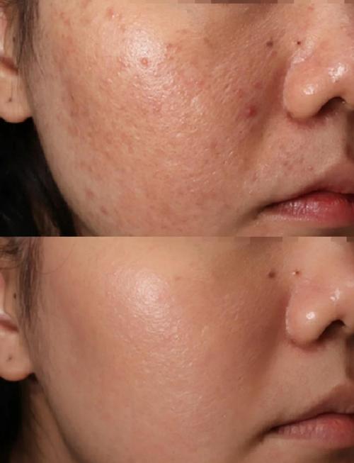 点阵激光祛痘印效果真的好吗？-图1