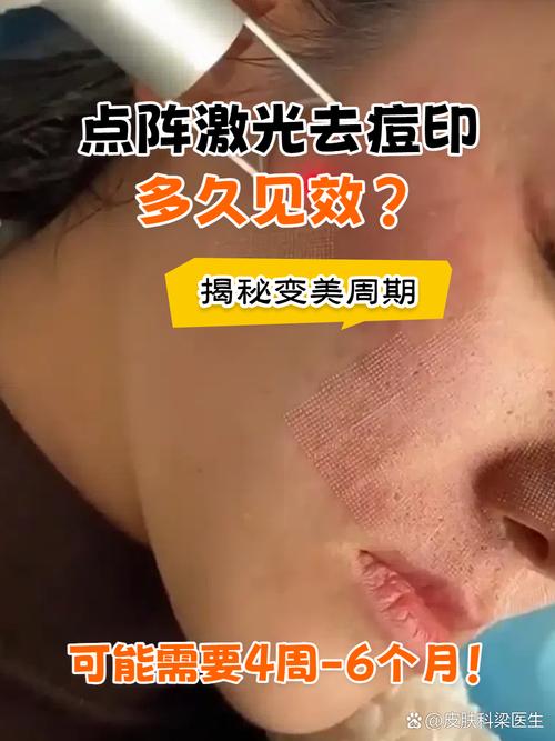 点阵激光祛痘印效果真的好吗？-图3