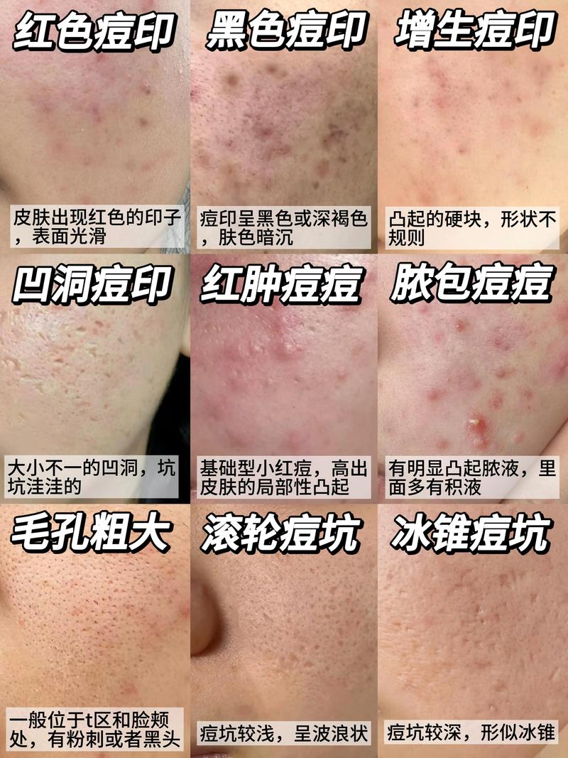 激光祛痘坑副作用有哪些？-图3