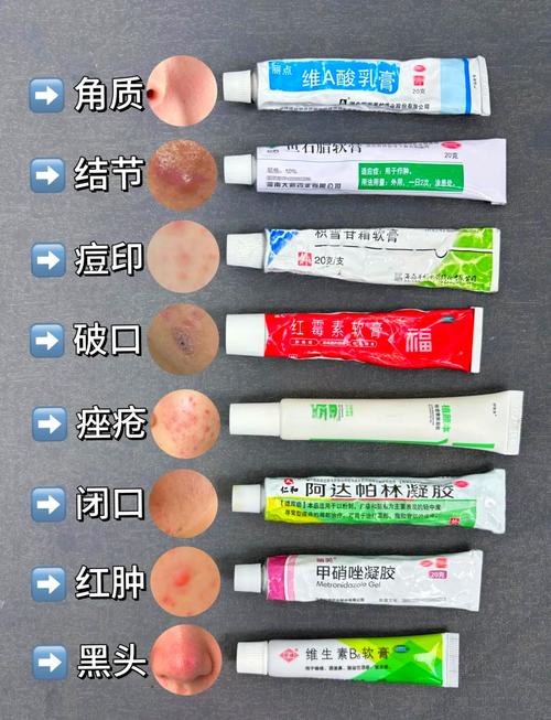 玫凯娜祛痘膏效果真的好吗？-图1